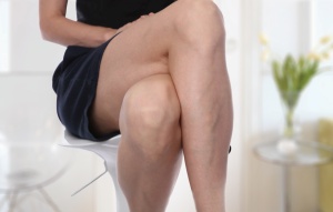 Are Spider Veins a Health Risk?