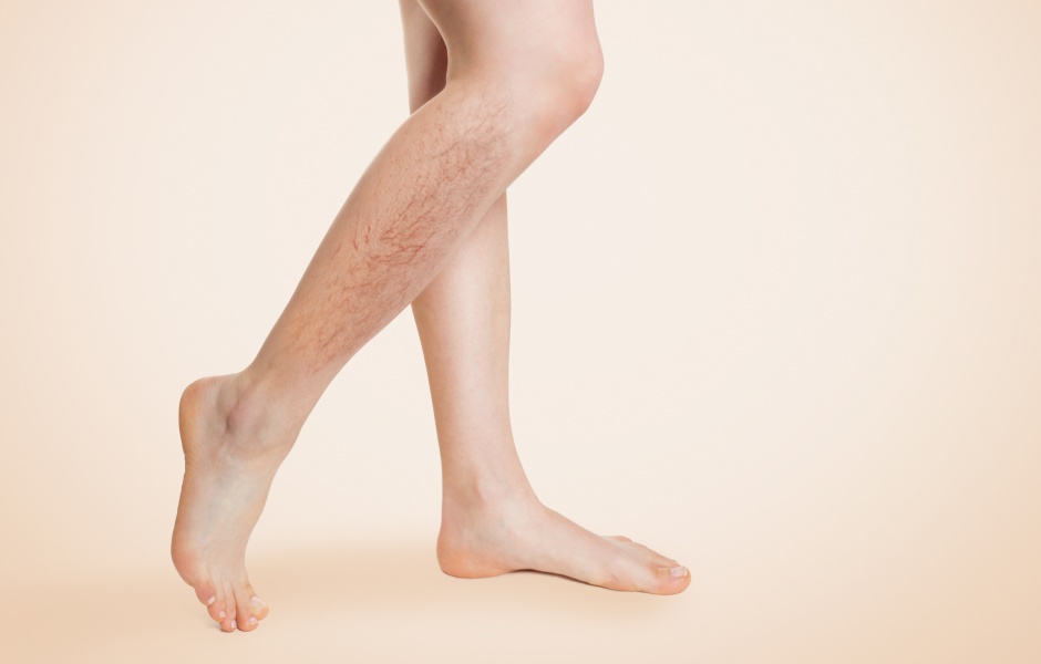 VenaSeal vs ClosureFast: Which Varicose Vein Solution Is Better for Me?