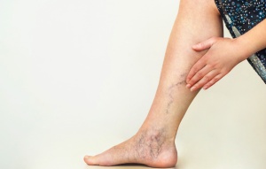 What Causes Spider Veins?