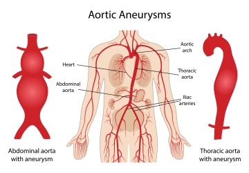 Aortic Aneurysms