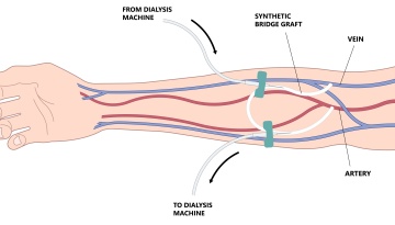 Hemodialysis Access Creation Maintenance