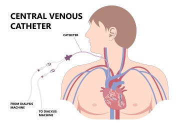 Central Venous Catheter