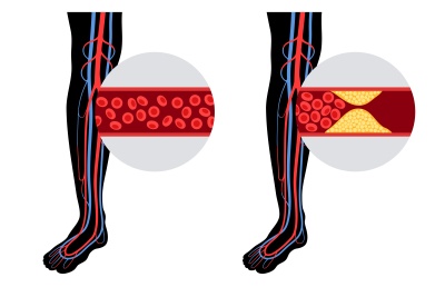 Peripheral Artery Disease